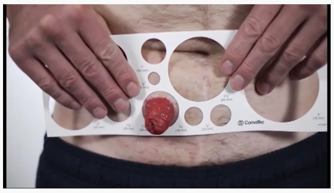 Mesurer votre stomie