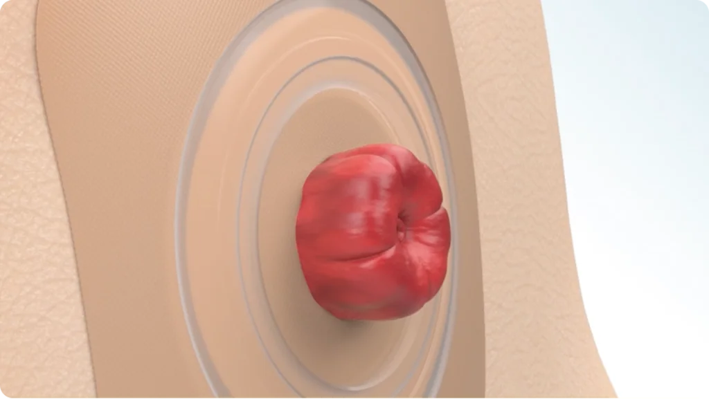 illustration showing what a stoma is