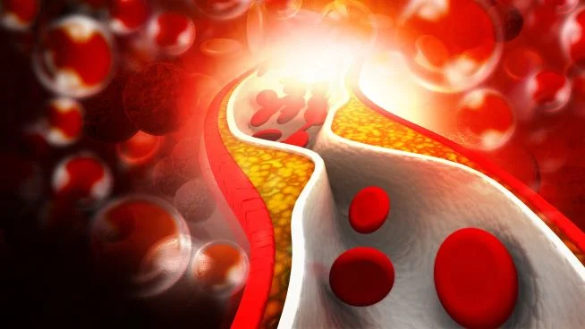 Cholesterinplaque in Arterien
