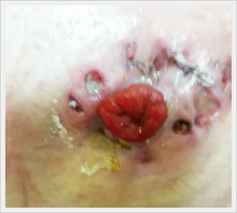 ZAKAŻENIA SKÓRY - BAKTERYJNE I GRZYBICZE.jpg