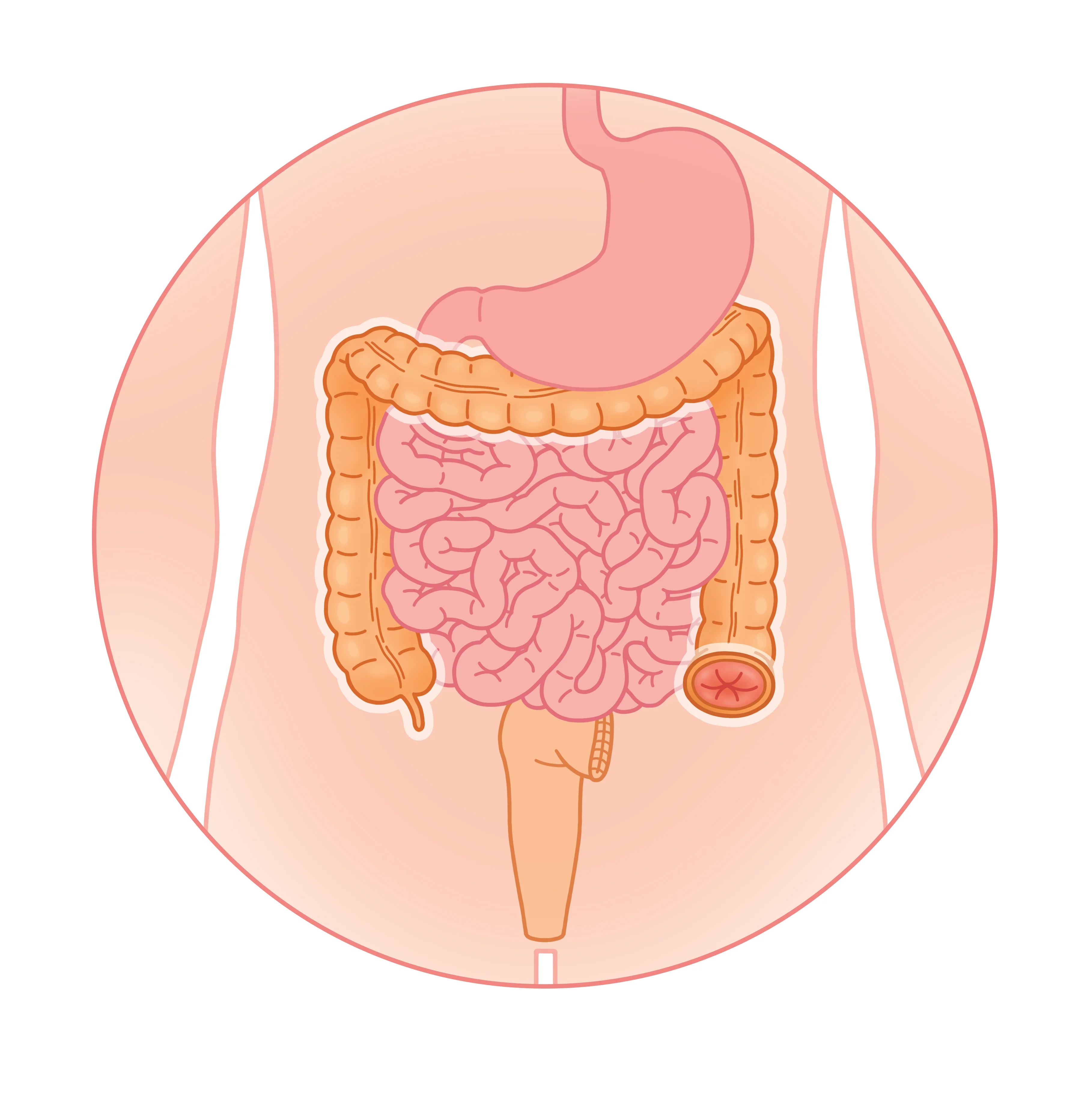Colostomie gauche